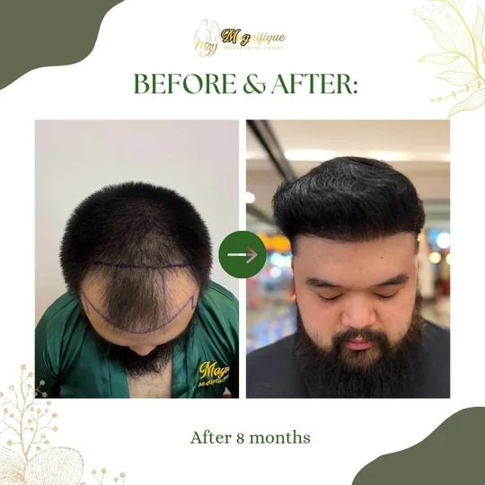 A thinning front before FUE, and a full head of hair 8 months after
